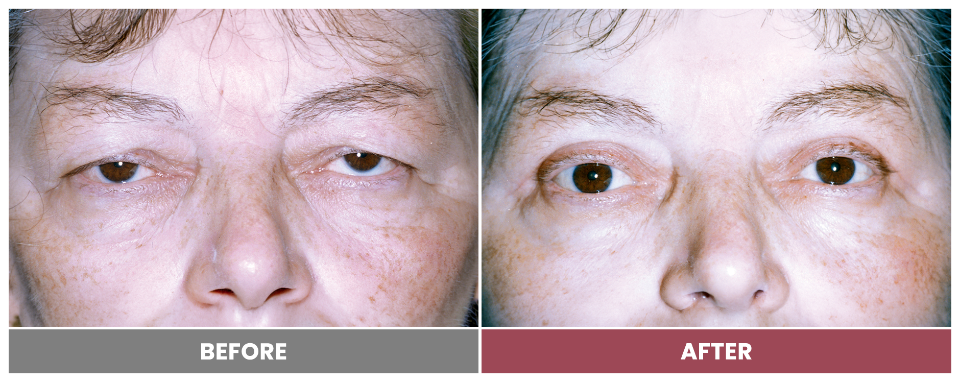 Upper Blepharoplasty - Case 30